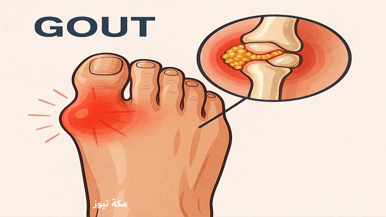 كل ما تريد معرفته عن النقرس.. الأعراض العلاج والأكل المناسب